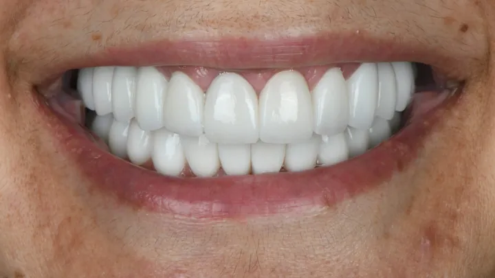 A smile from Dr. Dan Shaer's practice, case 02 after treatment