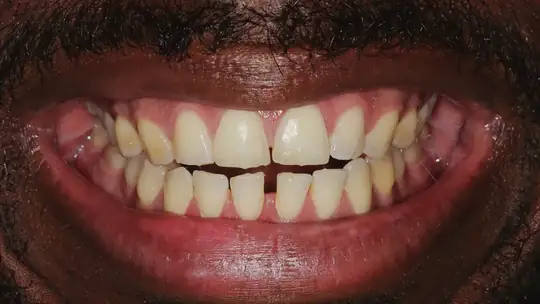 Case 04, before treatment