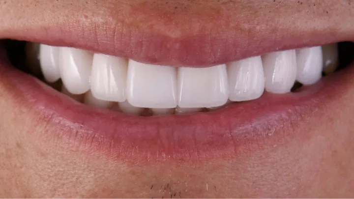 A smile from Dr. Dan Shaer's practice, case 09 after treatment