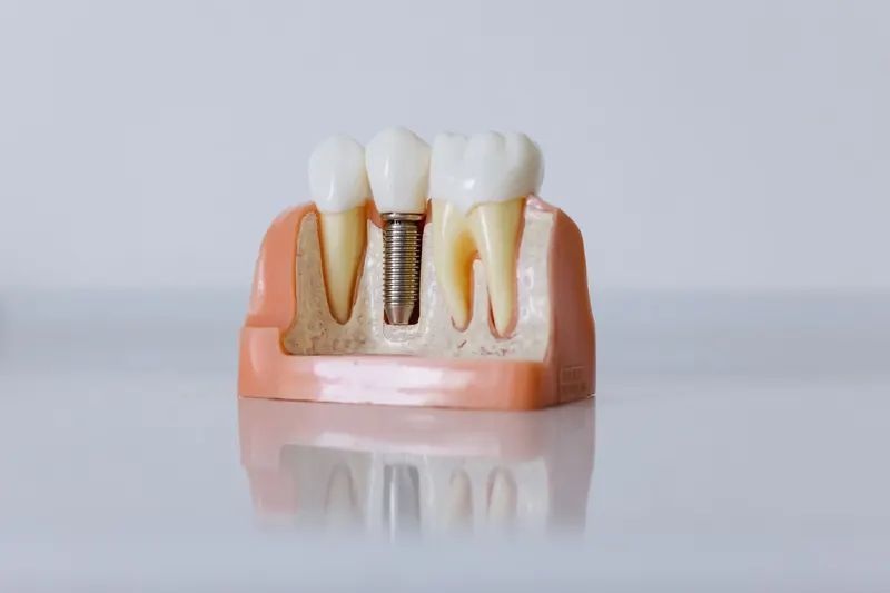 A cutaway model of a titanium implant set in the jaw beneath a crown